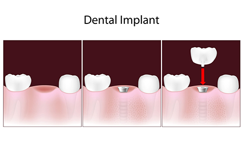 Dental Implants in West Orange