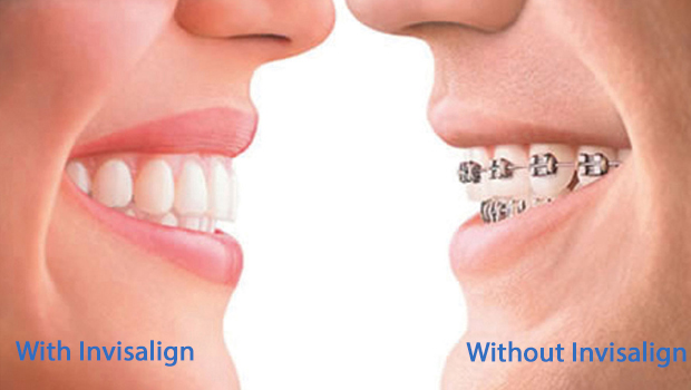 West Orange Invisalign